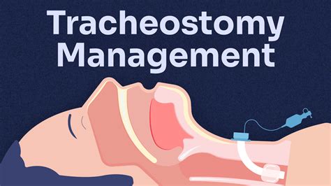 Update on management of tracheostomy .